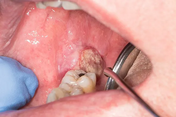 oral cancer 2
