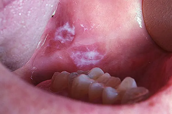 oral cancer 3